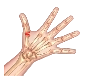 Thumb Arthritis