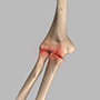 Elbow Arthritis