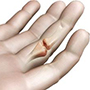 Arthritis of Hand and Wrist