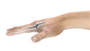 Artificial Finger Joint Replacement 