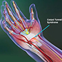 Carpal Tunnel Syndrome