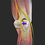 Cubital Tunnel Release