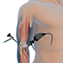 Elbow Arthroscopy