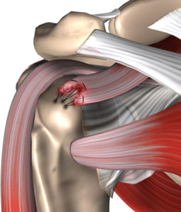 Arthroscopic Rotator Cuff Repair surgery, rotator cuff specialist